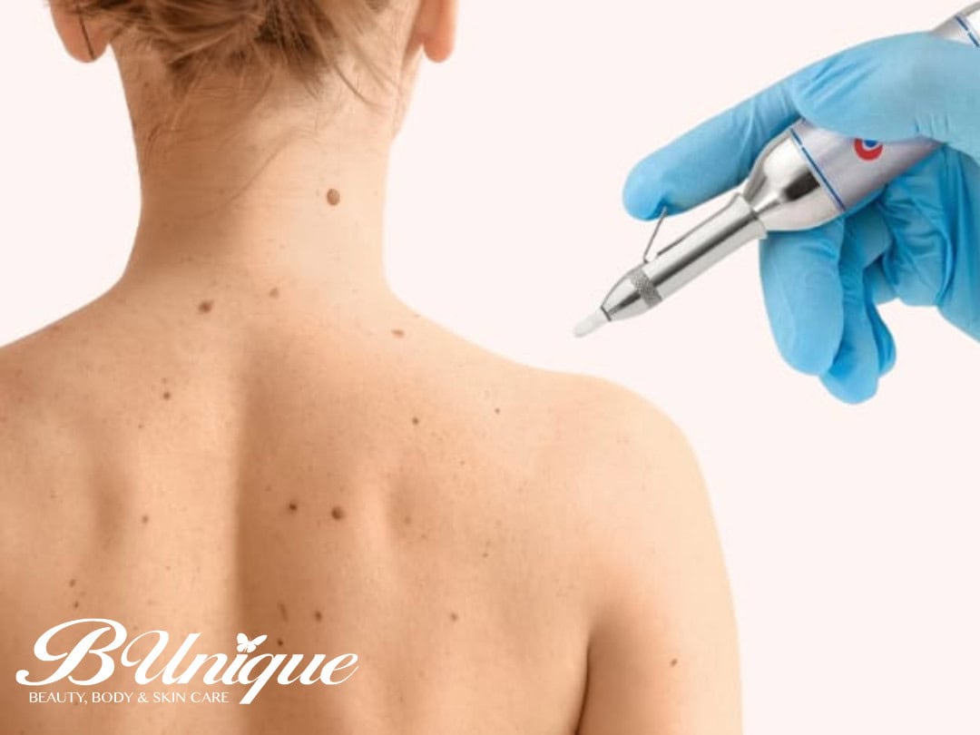 Therapist performing mole removal on back with laser treatment.