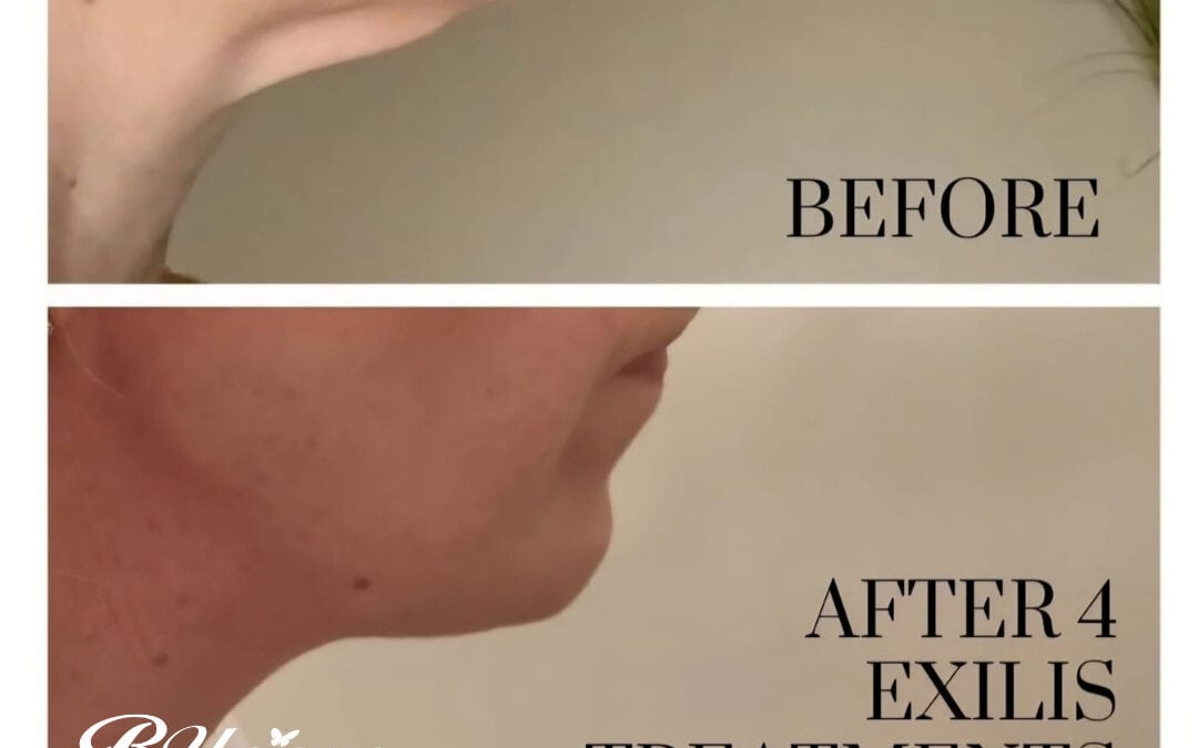 BTL Exilis Ultra 360