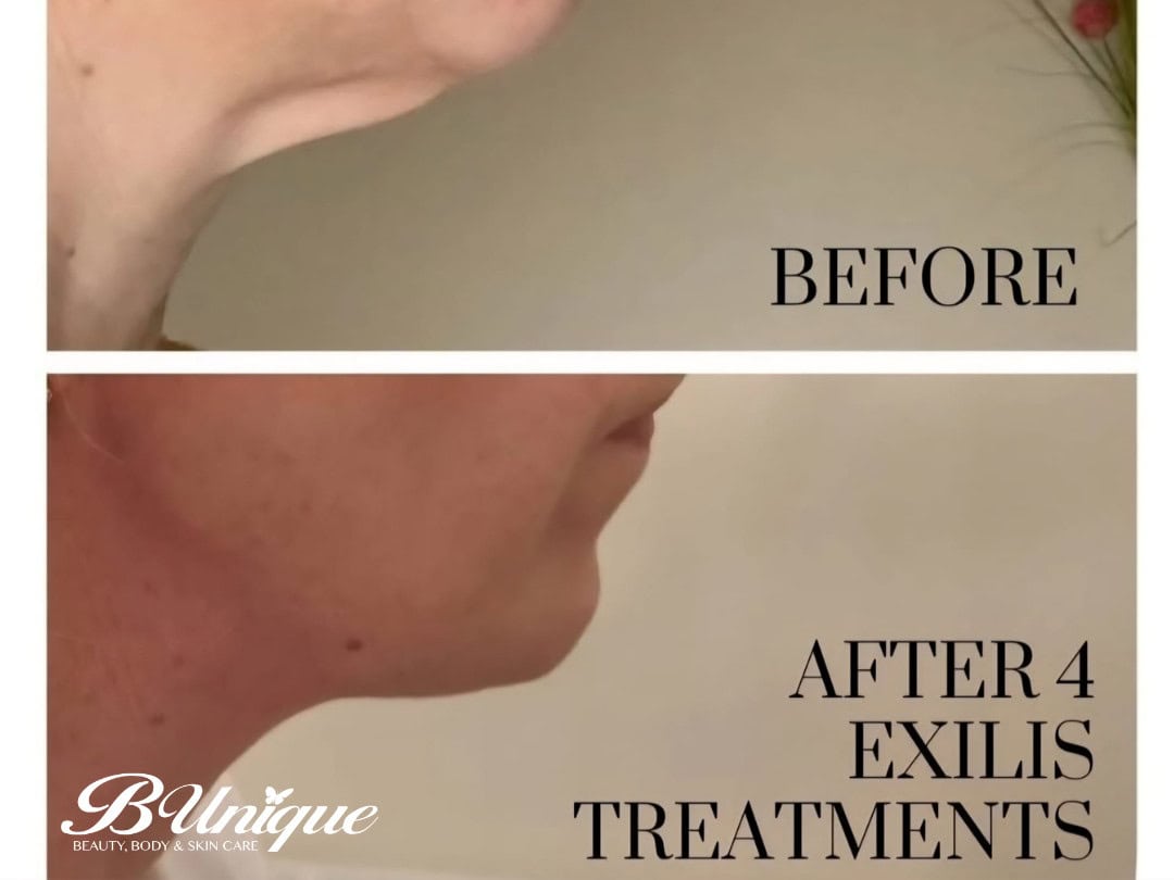 Skin tightening results after 4 Exilis treatments on the face.