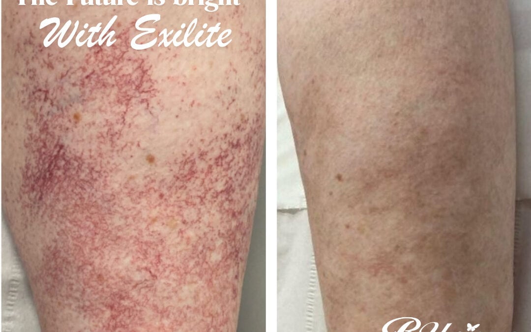 Exilite IPL treatment from BTL