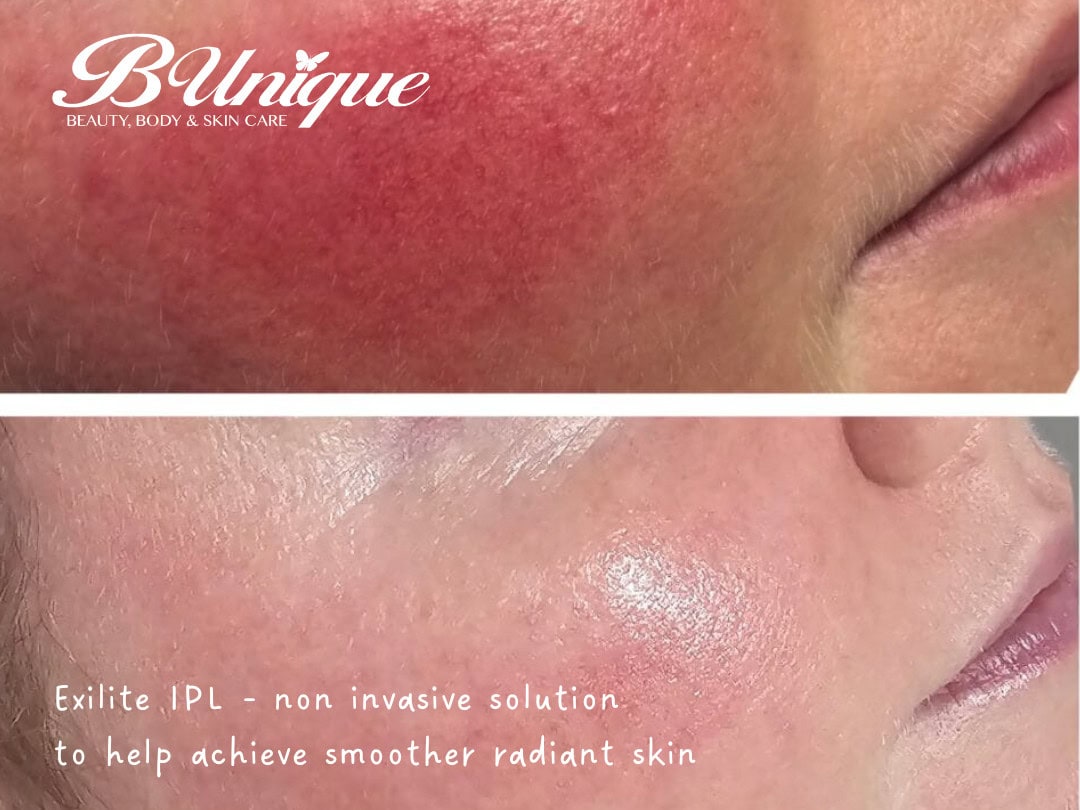 Exlite IPL non-invasive skin treatment for radiant skin at B-unique.